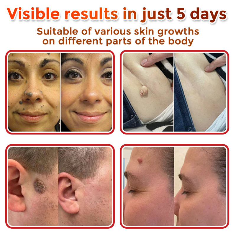 🇨🇦✨GFOUK® MicroNeedle Botanic Skin Tag Removal Patch 🇺🇸 Made in the USA