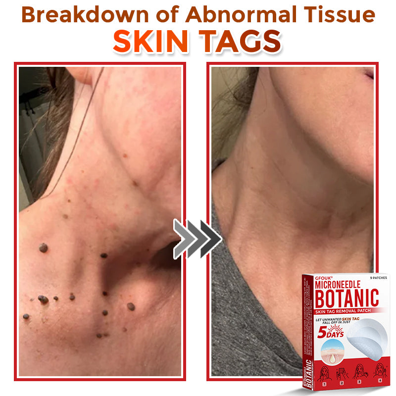 🇨🇦✨GFOUK® MicroNeedle Botanic Skin Tag Removal Patch 🇺🇸 Made in the USA