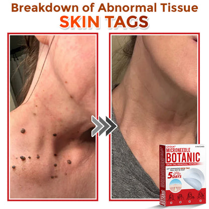 🇨🇦✨GFOUK® MicroNeedle Botanic Skin Tag Removal Patch 🇺🇸 Made in the USA