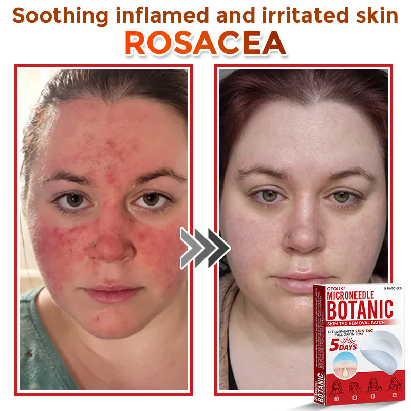 🇨🇦✨GFOUK® MicroNeedle Botanic Skin Tag Removal Patch 🇺🇸 Made in the USA
