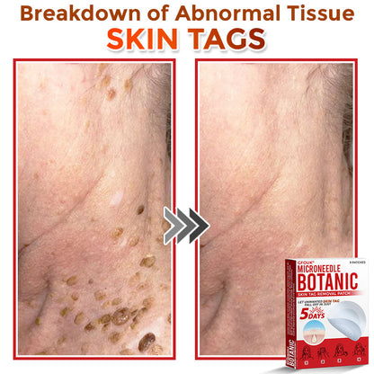 🇨🇦✨GFOUK® MicroNeedle Botanic Skin Tag Removal Patch 🇺🇸 Made in the USA