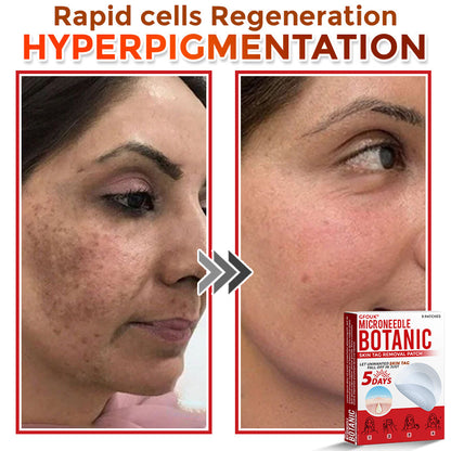 🇨🇦✨GFOUK® MicroNeedle Botanic Skin Tag Removal Patch 🇺🇸 Made in the USA