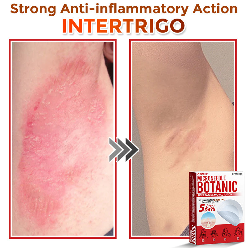 🇨🇦✨GFOUK® MicroNeedle Botanic Skin Tag Removal Patch 🇺🇸 Made in the USA