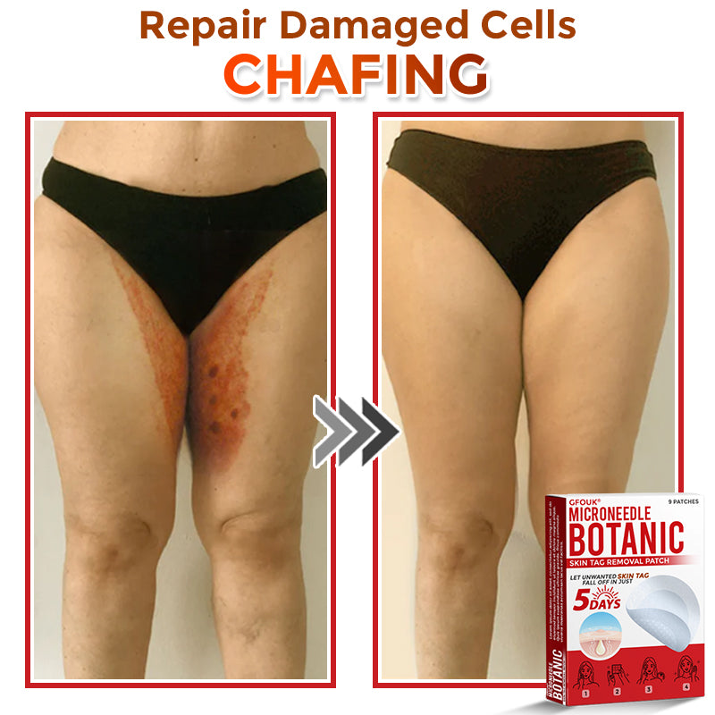 🇨🇦✨GFOUK® MicroNeedle Botanic Skin Tag Removal Patch 🇺🇸 Made in the USA