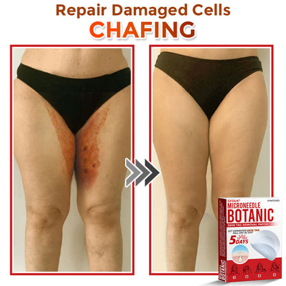 🇨🇦✨GFOUK® MicroNeedle Botanic Skin Tag Removal Patch 🇺🇸 Made in the USA