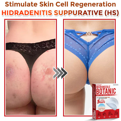 🇨🇦✨GFOUK® MicroNeedle Botanic Skin Tag Removal Patch 🇺🇸 Made in the USA
