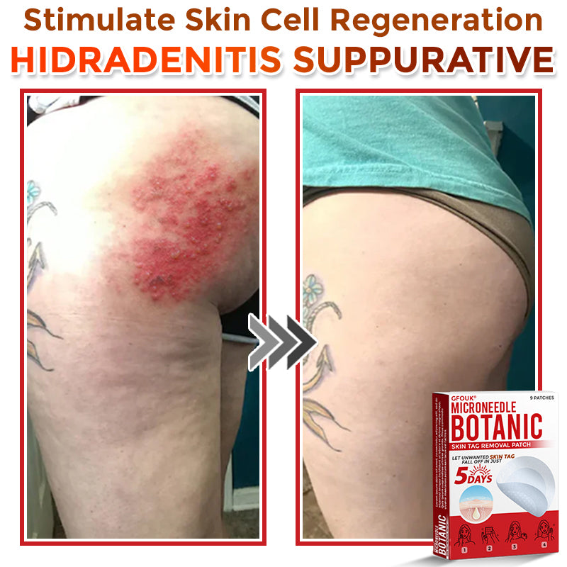 🇨🇦✨GFOUK® MicroNeedle Botanic Skin Tag Removal Patch 🇺🇸 Made in the USA