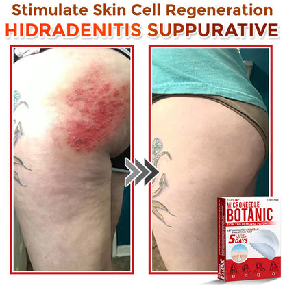 🇨🇦✨GFOUK® MicroNeedle Botanic Skin Tag Removal Patch 🇺🇸 Made in the USA
