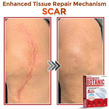 🇨🇦✨GFOUK® MicroNeedle Botanic Skin Tag Removal Patch 🇺🇸 Made in the USA